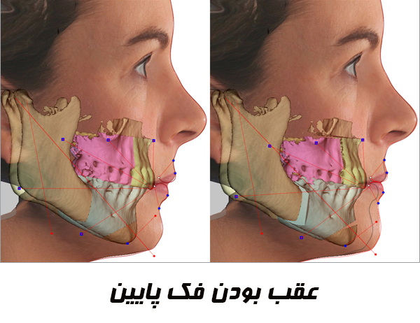 عقب بودن فک پایین