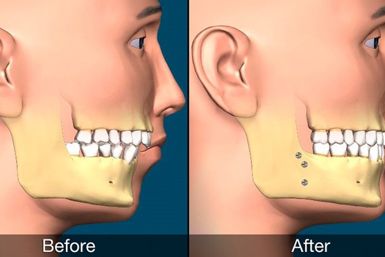 ارتودنسی به همراه جراحی فک