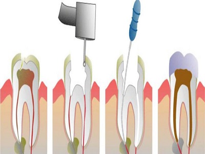 درمان ريشه دندان چيست؟