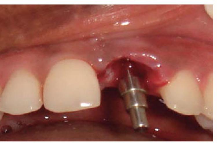عوامل شکست ایمپلنت دندان چه هستند؟