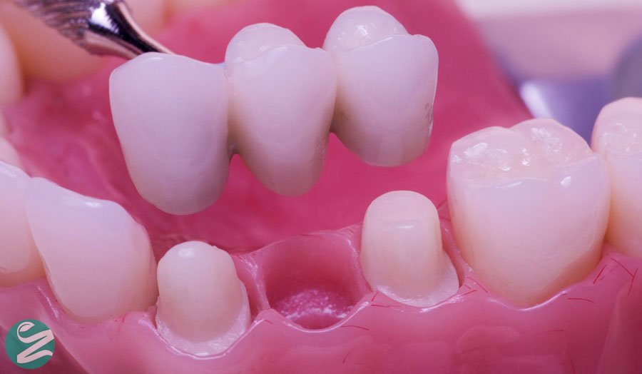 ایمپلنت و بریج دندان چه تفاوت هایی دارند؟