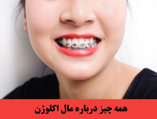 مال اکلوژن چگونه بوجود می آید؟