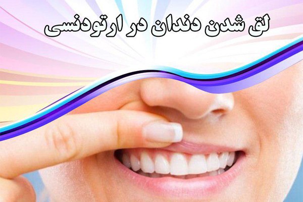 لق شدن دندان در ارتودنسی