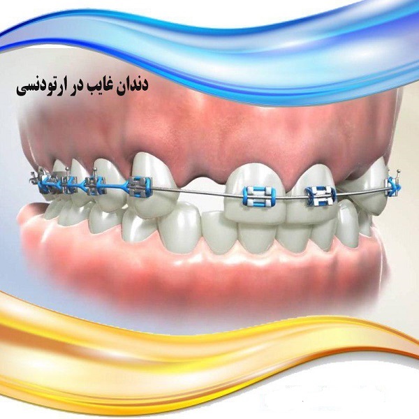 دندان غایب در ارتودنسی