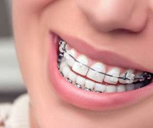 اصلاح مشکلات فک و دندان با ارتودنسی