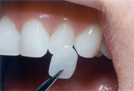 مراحل انجام لمینت دندان