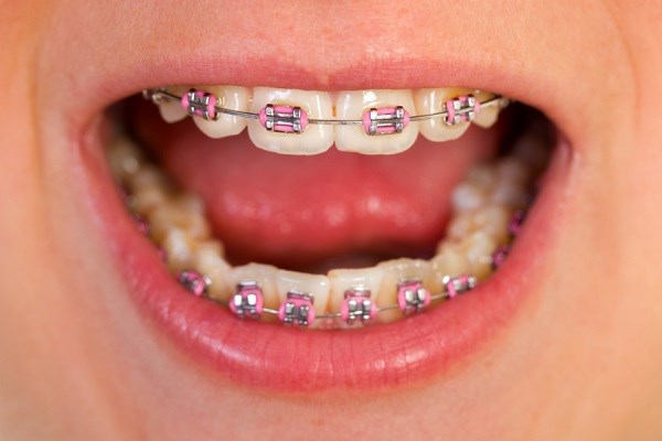 مهم ترین مشکلات ارتودنسی دندان