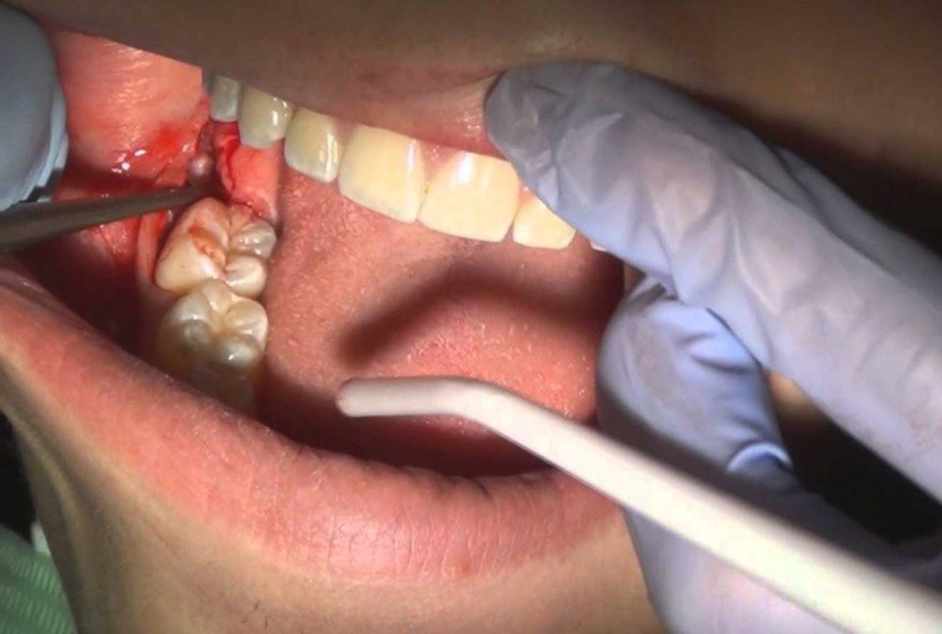 عوارض جراحی دندان