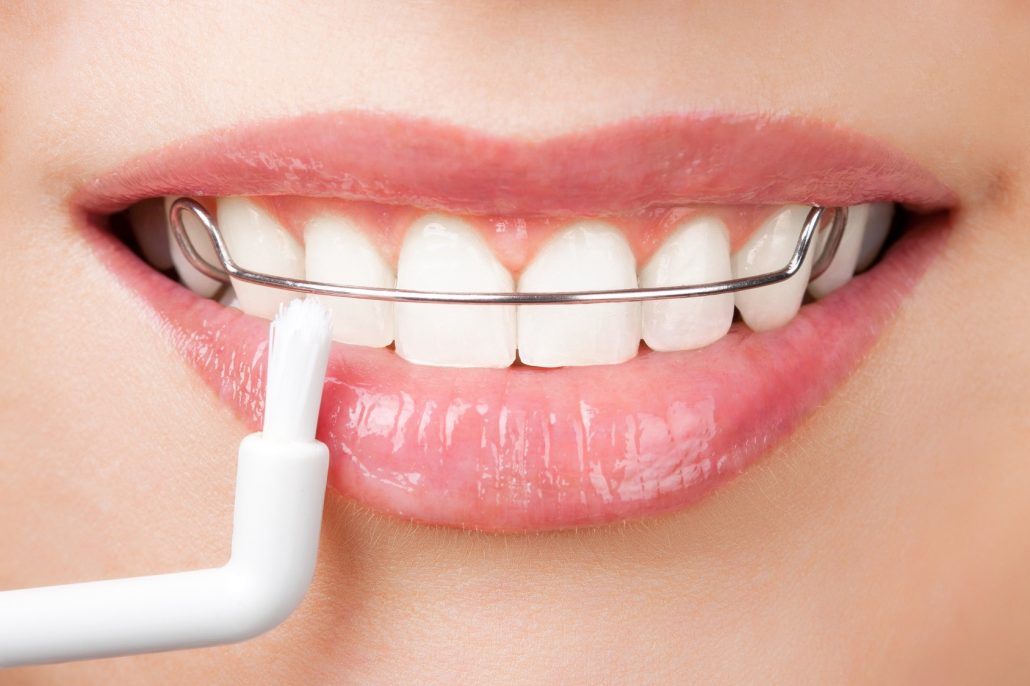 ارتودنسی برای یک دندان