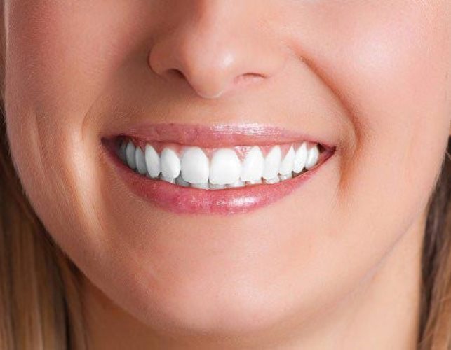 نکات مهم در بلیچینگ دندان