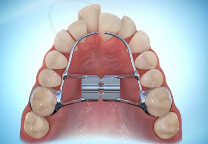 اکسپندر دندان چیست؟