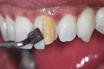 لمینیت کامپوزیتی دندان