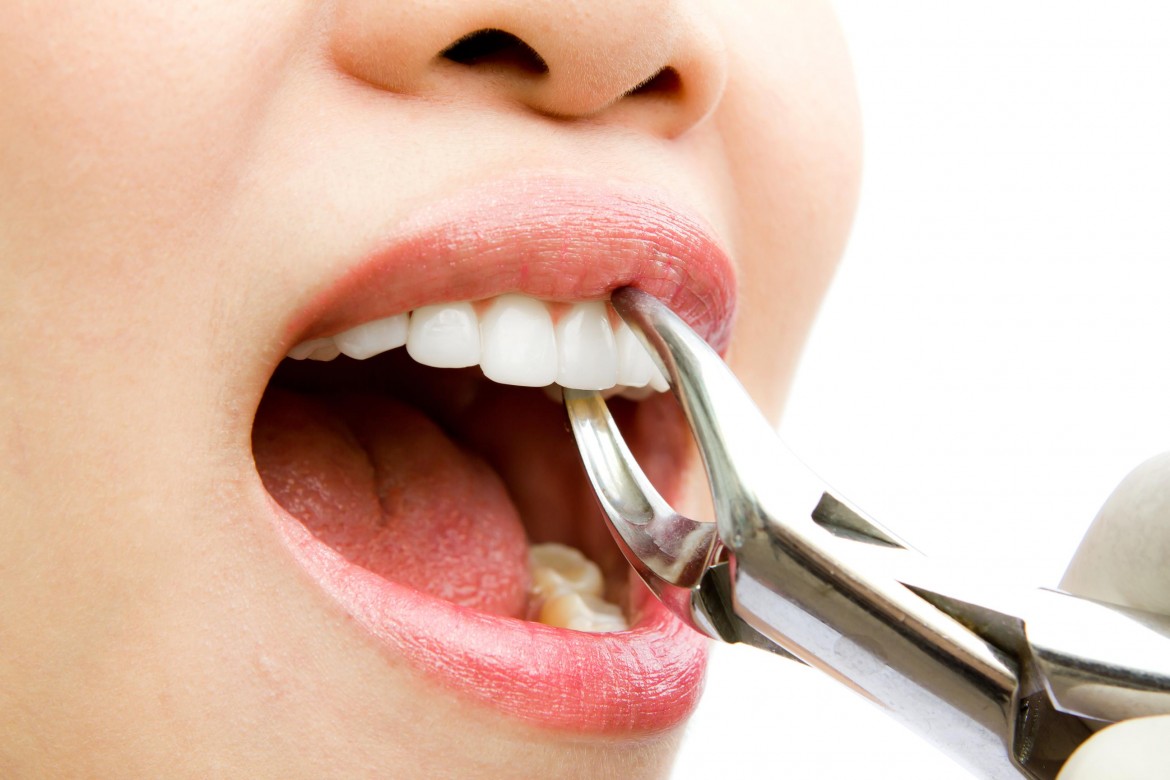 کشیدن دندان بهتراست یا درمان ریشه؟