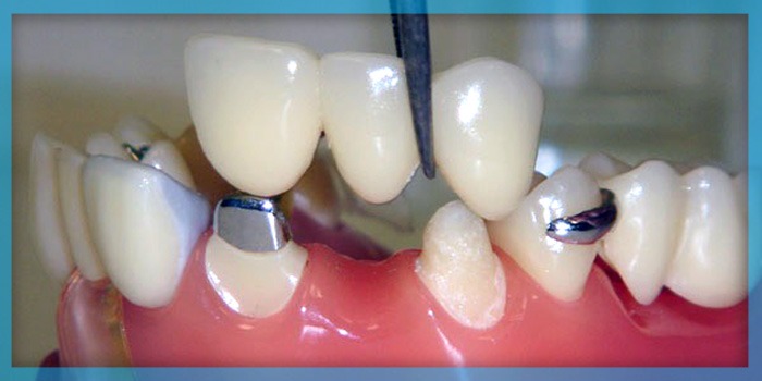 انواع بریج دندان: