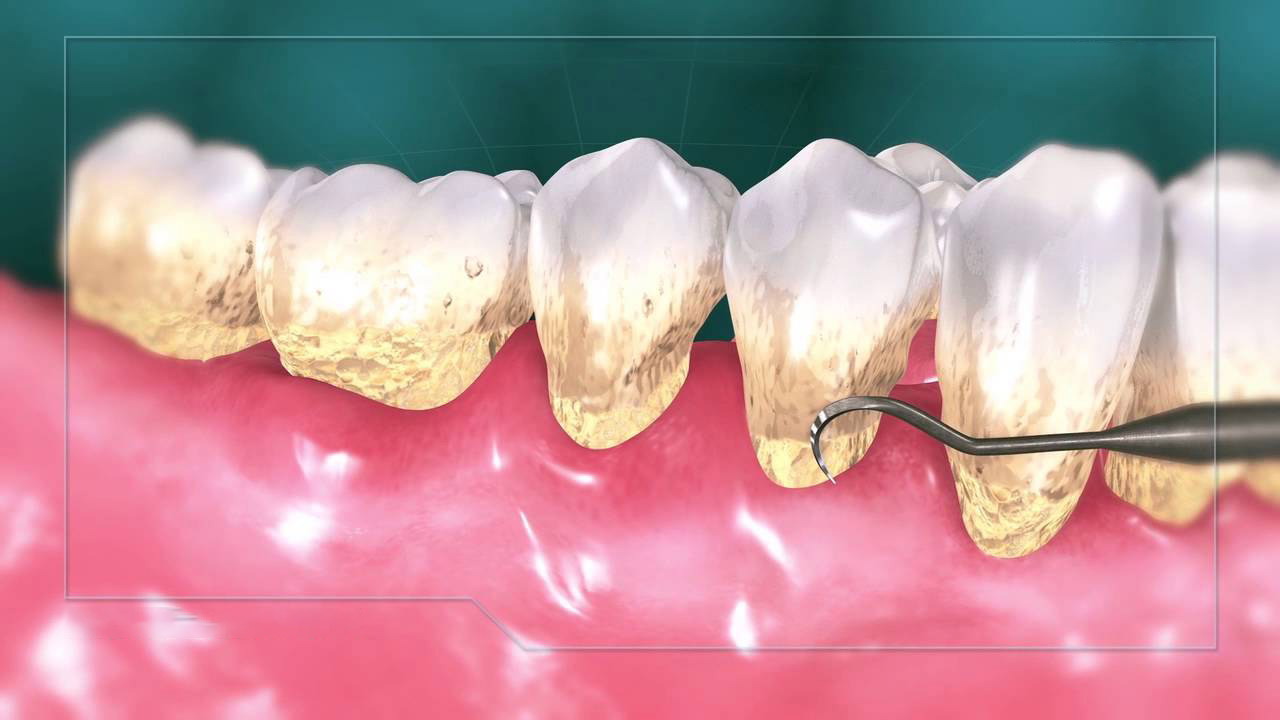  جرم گیری دندان به چند طریق انجام می شود؟