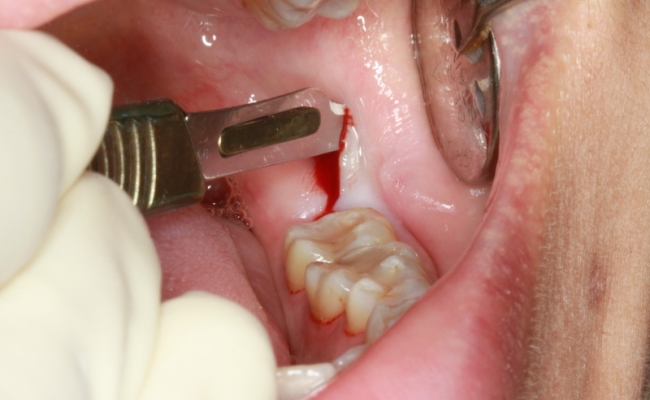 کاشت ایمپلنت بعد از کشیدن دندان