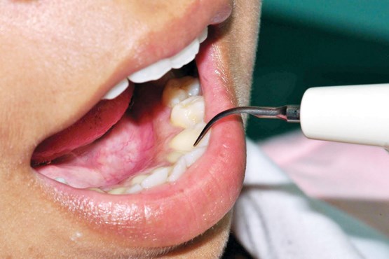 خطر قرار گرفتن در معرض پرتوهای لیزر در زمان سفید کردن دندان‌ها چگونه کنترل می‌شود؟