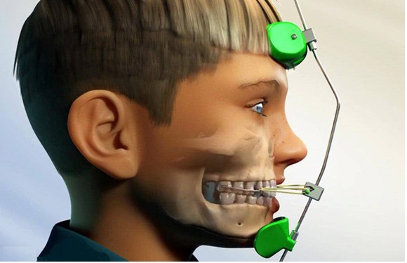 فیس ماسک ارتودنسی چیست؟ 