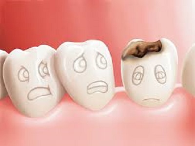 پوسیدگی دندان چیست؟
