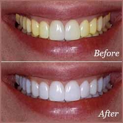 فواید و معایب و عوارض بلیچینگ دندان