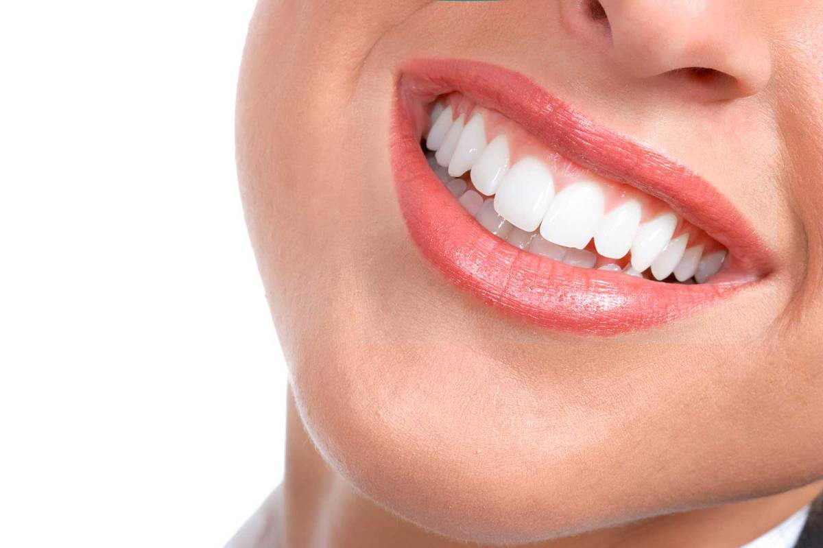 درباره لامینیت دندان چه می دانیم؟
