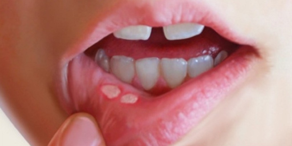 روش های مراقبت از ایمپلنت دندان