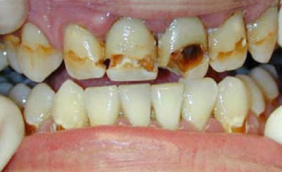 ارتباط پوسیدگی دندان و عوامل ژنتیکی چگونه است ؟