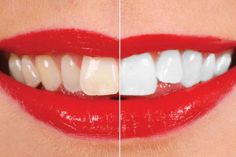 سفید کردن دندان‌ها یا بیلیچینگ