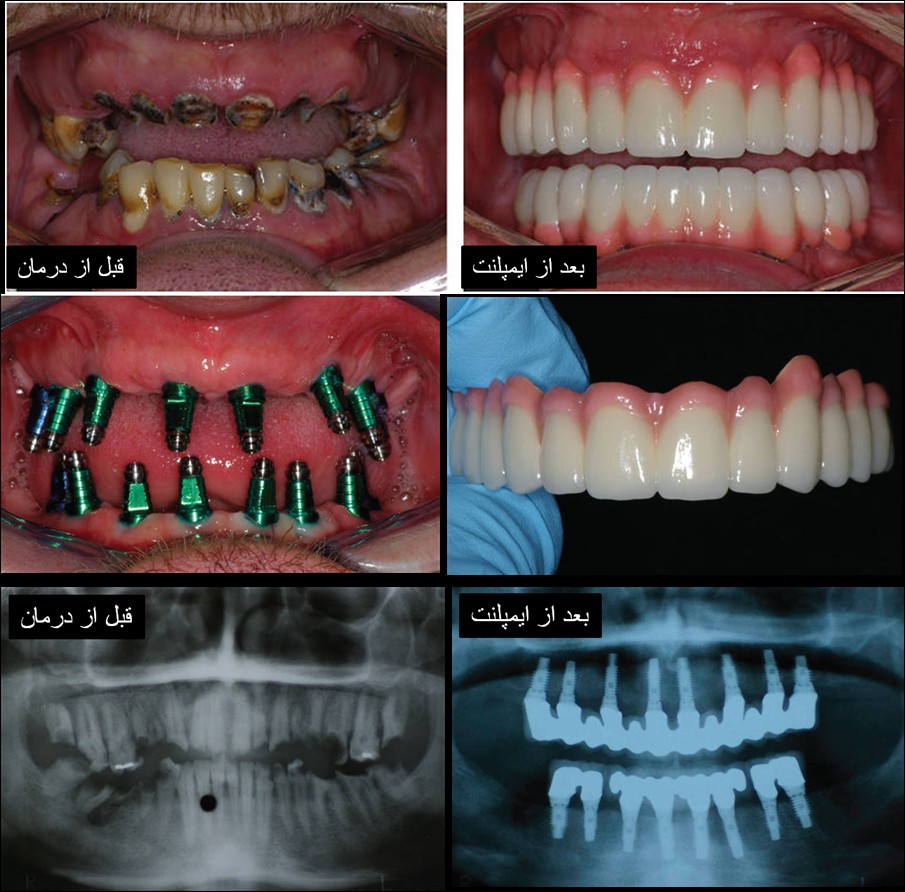 مراحل کاشت ایمپلنت دندان