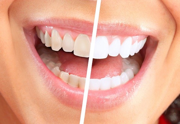 لمینت دندان یا ارتودنسی فوری : 