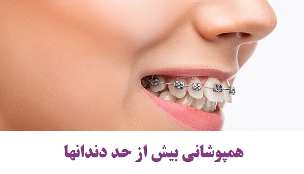 راه درمان همپوشانی دندانها