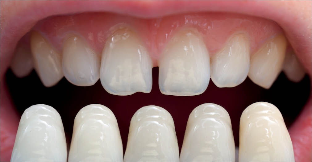 روش کار دندانپزشکان زیبایی در انجام لمینت دندان