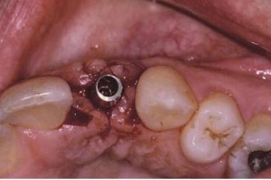 ایمپلنت دندانی جدید با قابلیت کاهش عفونت
