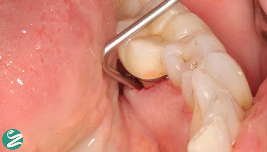 انواع عفونت دندان