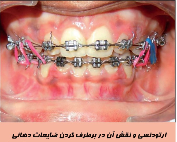 نقش ارتودنسی در برطرف کردن ضایعات دهانی