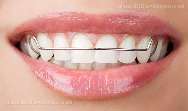 آیا دندان عقل باید قبل از درمان ارتودنسی کشیده شود؟