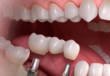 ایمپلنت های فوق کوتاه تحولی نو در دندانپزشکی