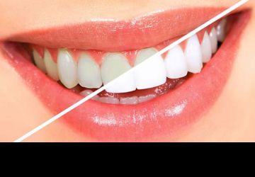 سفید کردن دندان، از بلیچینگ تا لمینت