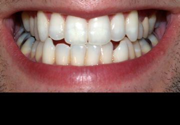 آیا تمام دندان‌ها به یک اندازه سفید می‌شوند؟