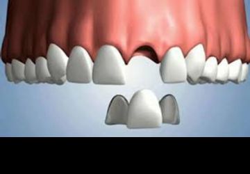 بریج دندان چیست؟ 