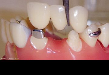 چه افرادی مناسب برای استفاده از بریج های دندانی هستند؟