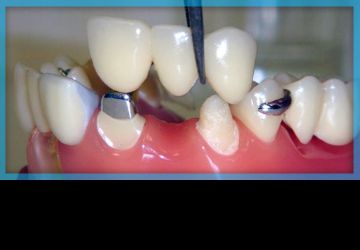 انواع بریج دندان: