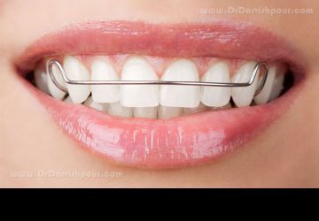 آیا دندان عقل باید قبل از درمان ارتودنسی کشیده شود؟