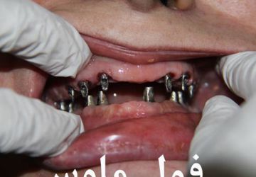 برسازی درون‌کاشت دندانی یا پروتز ایمپلنت دندانی 