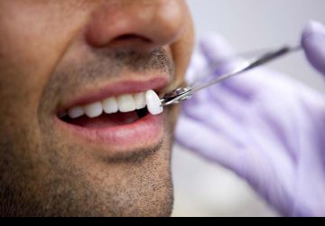 راه کارهایی برای افزایش ماندگاری لمینت دندان