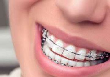 اصلاح مشکلات فک و دندان با ارتودنسی