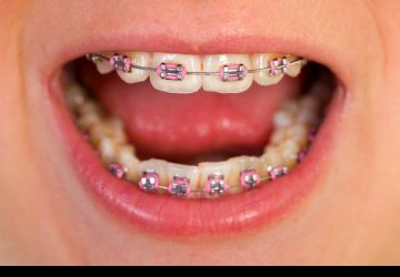 مهم ترین مشکلات ارتودنسی دندان