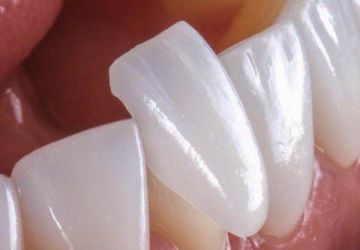 عوارض عدم رعایت بهداشت روکش دندان