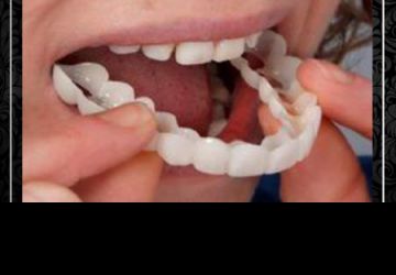 مراحل لمینت کامپوزیت ونیر دندانها