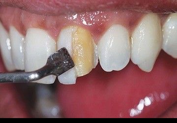 لمینیت کامپوزیتی دندان